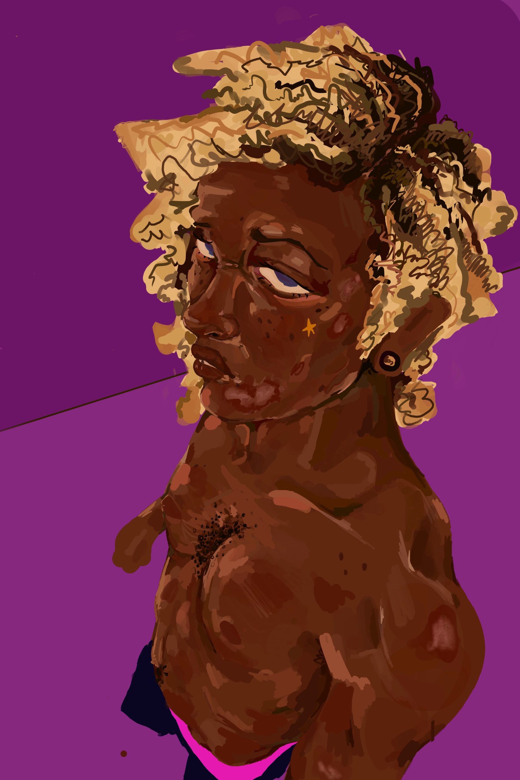Eczema